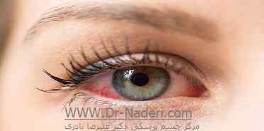 خشکی چشم بعد از لیزیک Post LASIK Dry Eye